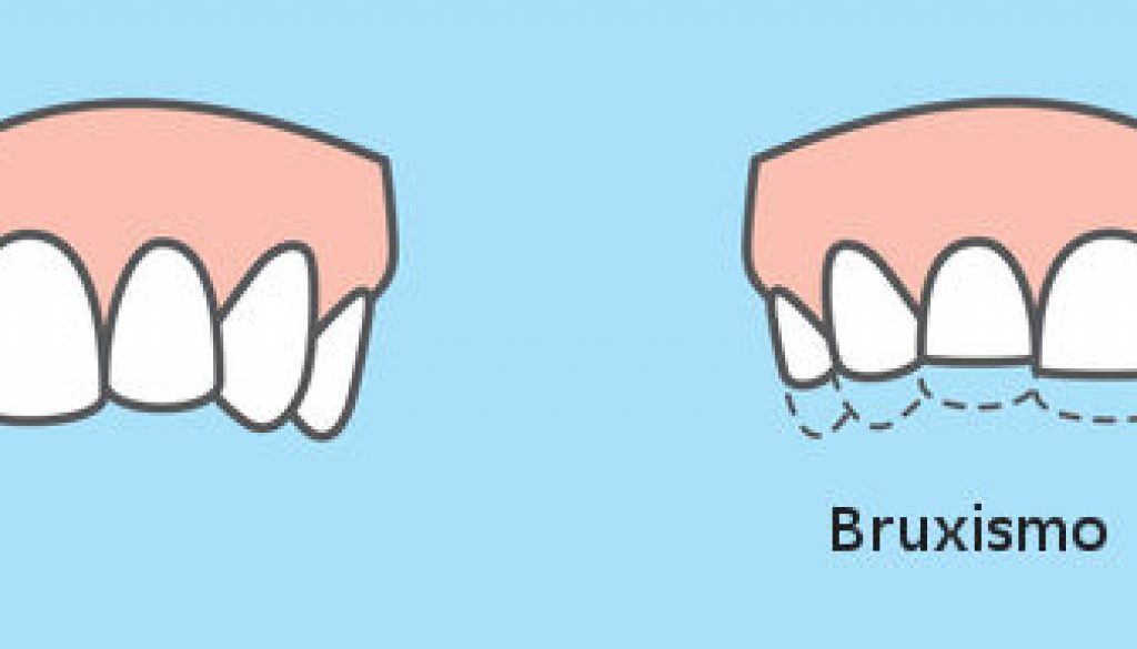 bruxismo