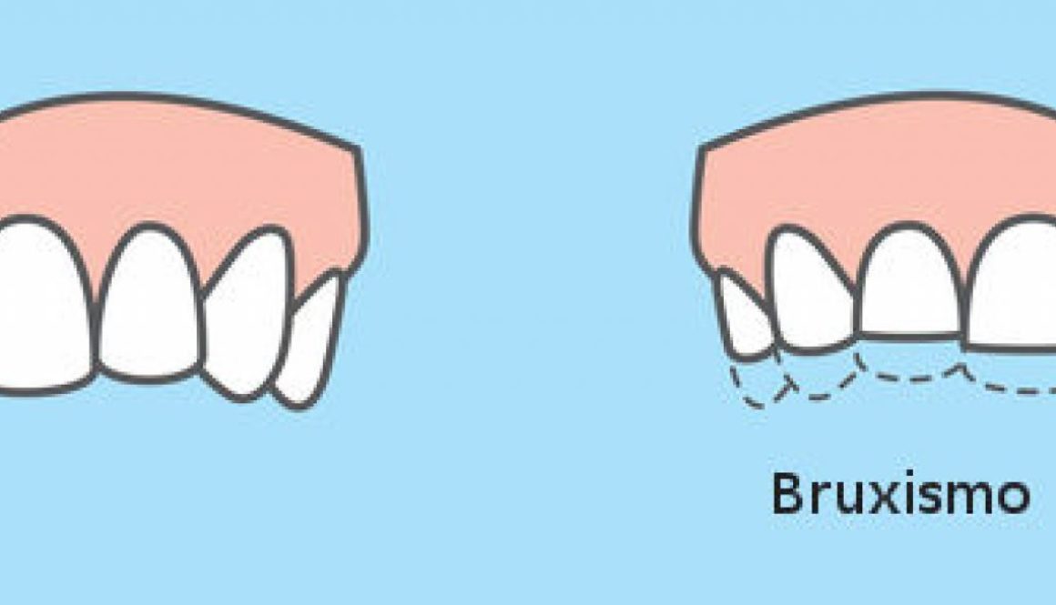 bruxismo