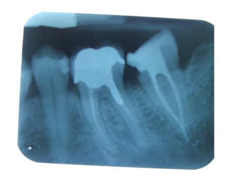 endodonzia1